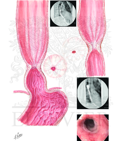 Esophageal Strictures