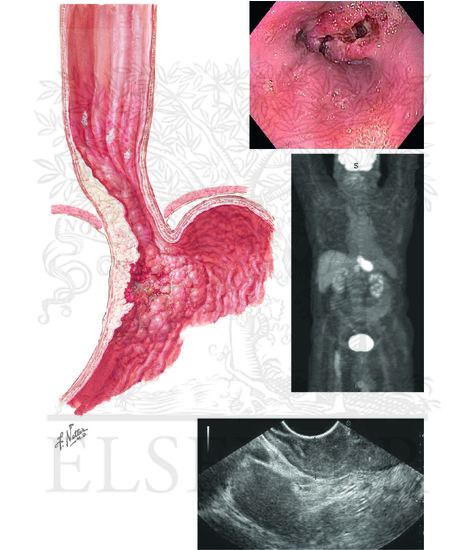 Watermarked preview of unlabeled image: Adenocarcinoma of the Esophagus