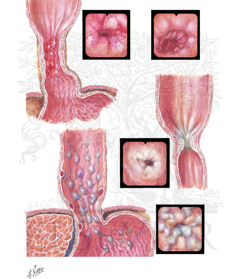 Esophageal Varices