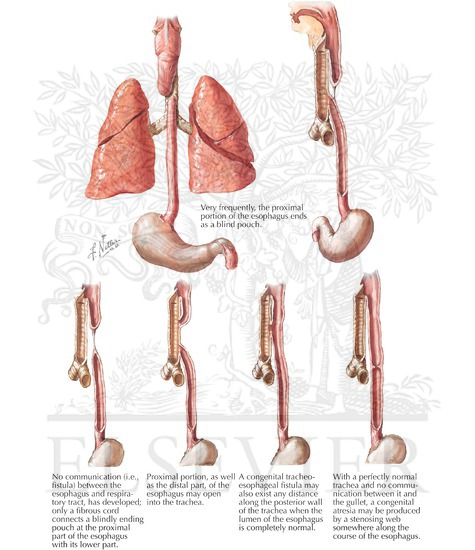 Congenital Esophageal Stenosis 