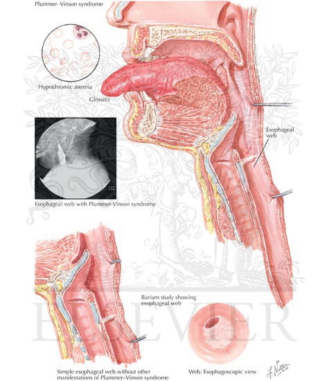 plummer vinson syndrome