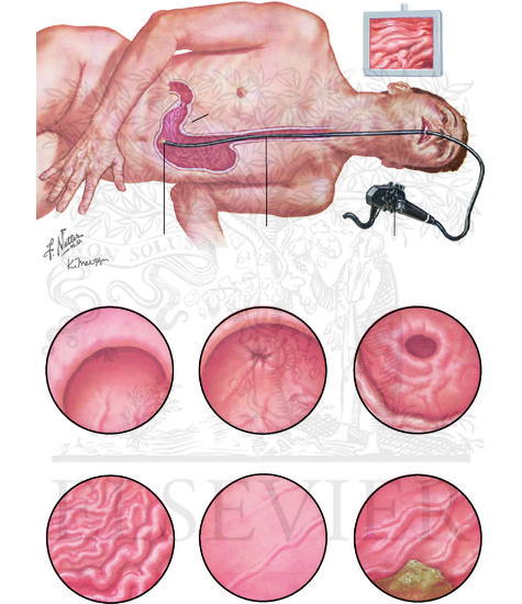 Watermarked preview of unlabeled image: Endoscopic Evaluation of the Stomach: Upper Endoscopy