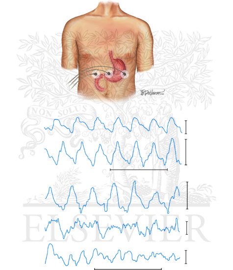 Diagnostic Aids in Gastric Disorders: Electrogastrography