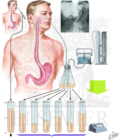 Gastric Analysis