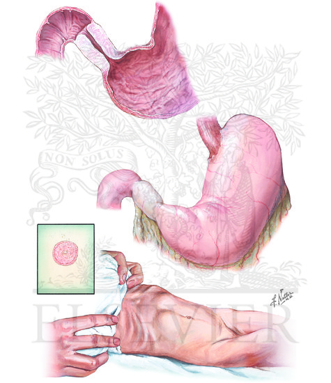 Watermarked preview of unlabeled image: Hypertrophic Pyloric Stenosis
