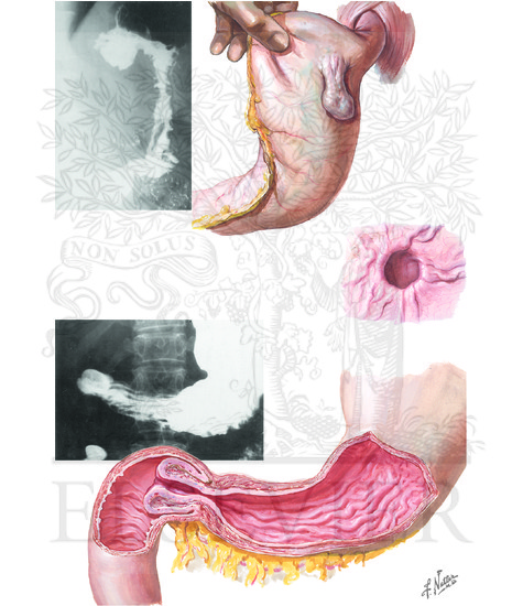 Diverticulum of Stomach; Gastroduodenal Prolapse
