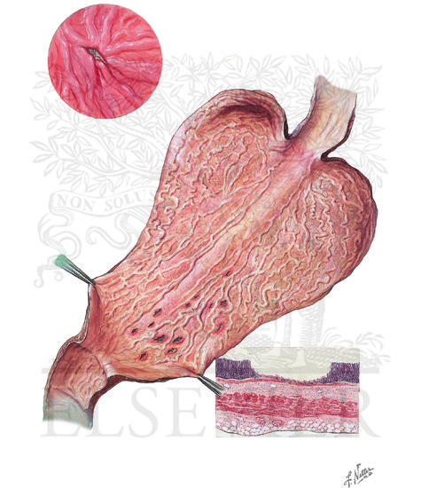 Watermarked preview of unlabeled image: Acute Gastric Ulcer