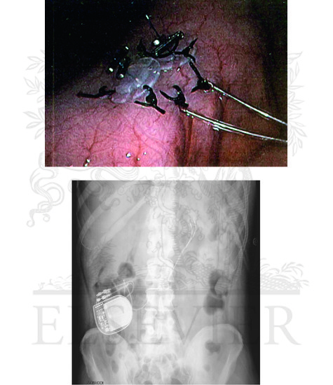 Watermarked preview of unlabeled image: Gastric Electrical Stimulation for Gastroparesis