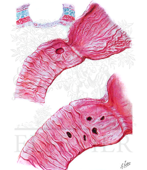 Watermarked preview of unlabeled image: Peptic Ulcer:  Duodenitis and Ulcer of Duodenal Bulb