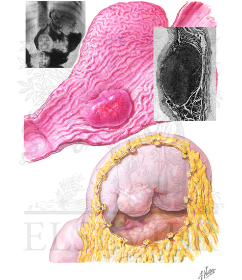 Watermarked preview of unlabeled image: Benign Tumors of Stomach (Continued)