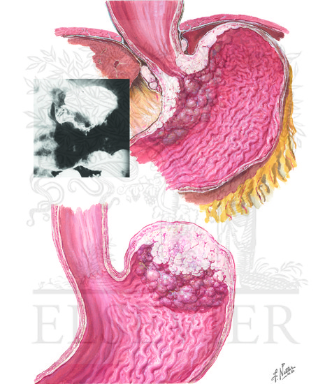 Carcinoma Of Stomach Near Cardia And In Fundus