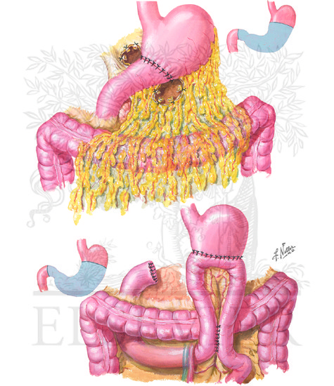 Principles of Operative Procedures: Partial Gastrectomy and Billroth Anastamoses