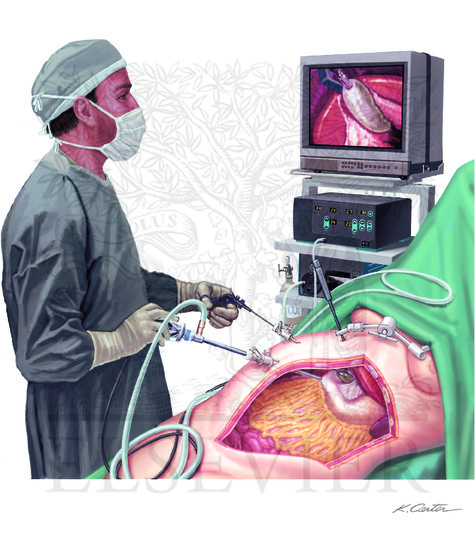 Laparoscopic Peritoneoscopy