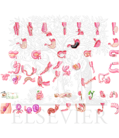 Watermarked preview of unlabeled image: Overview of Digestive Tract Obstructions (CONTINUED): Acquired Causes of Obstruction