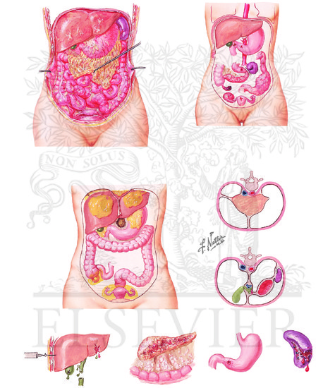 Acute Peritonitis