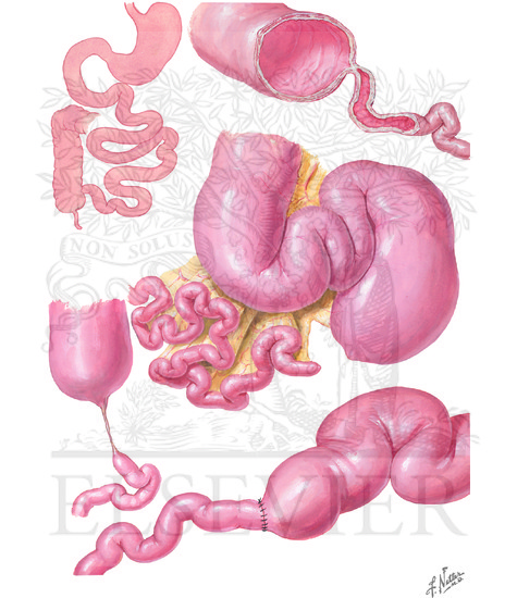 Watermarked preview of unlabeled image: Congenital Intestinal Obstruction:  Intestinal Atresia, Malrotation of Colon, Volvulus of Midgut: Congenital Intestinal Atresia