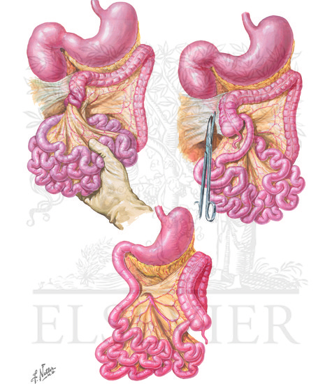 Watermarked preview of unlabeled image: Congenital Intestinal Obstruction:  Intestinal Atresia, Malrotation of Colon, Volvulus of Midgut (continued): Malrotation of Colon and Volvulus of Midgut