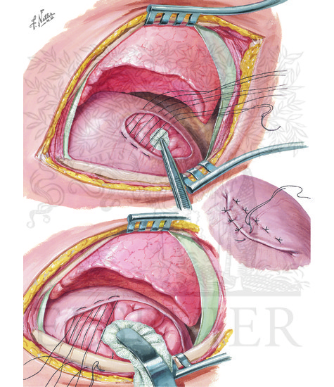 Watermarked preview of unlabeled image: Diaphragmatic Hernia (CONTINUED): Thoracic Approach To Repair Of Diaphragmatic Hernia