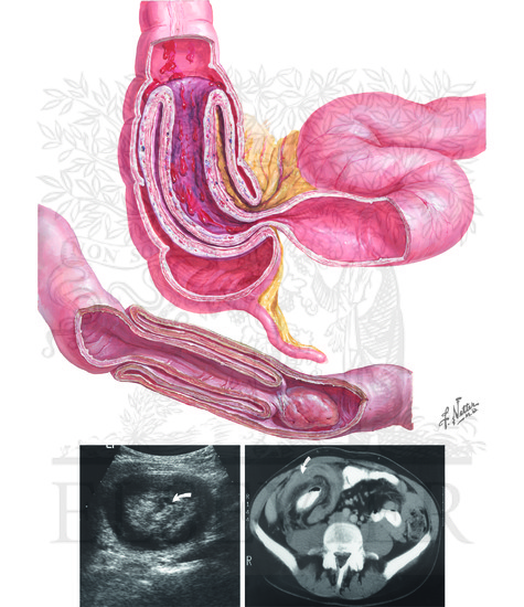 Watermarked preview of unlabeled image: Intussusception