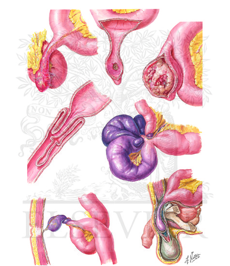 Meckel's Diverticulum: Complications of Meckel Diverticulum and Vitelline Duct Remnants