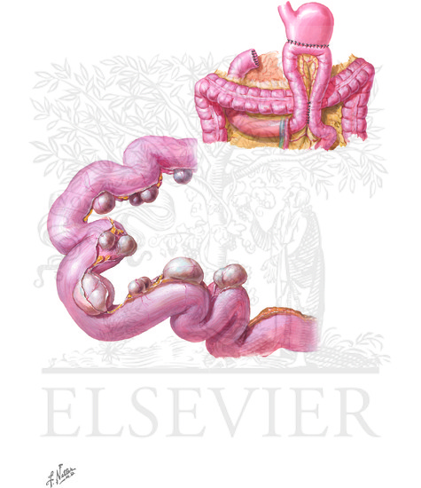 Watermarked preview of unlabeled image: Bacterial overgrowth