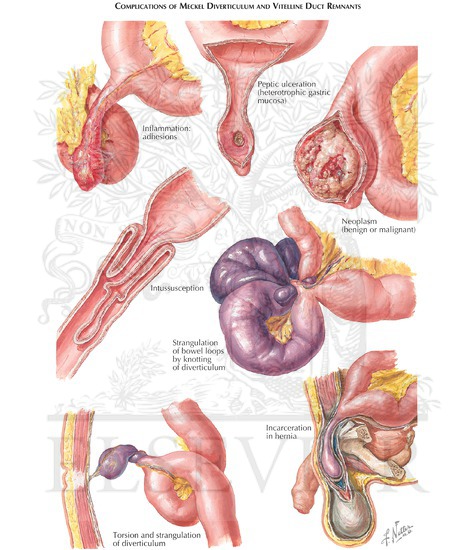 Meckel's Diverticulum: Complications of Meckel Diverticulum and Vitelline Duct Remnants