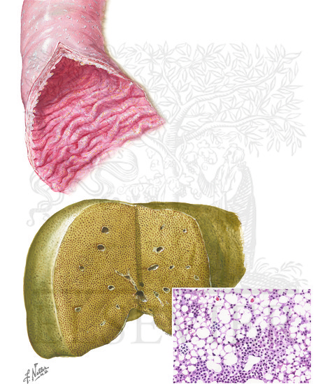 Watermarked preview of unlabeled image: Lymphangiectasia and Abetalipoprotein Deficiency