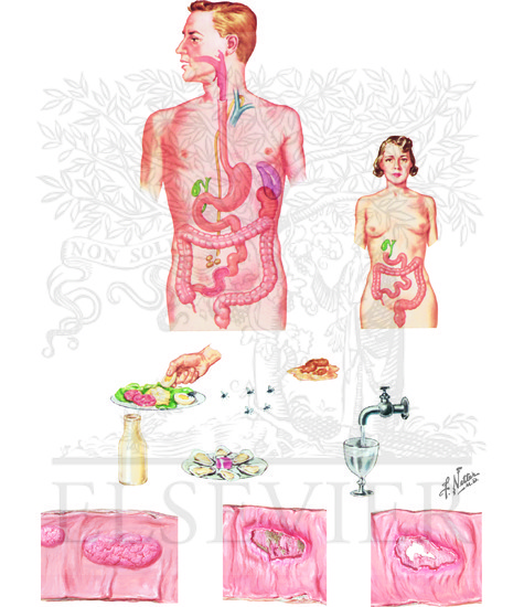 Typhoid Fever: Typhoid Fever: Transmission and Pathologic Lesions
