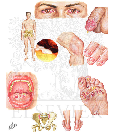 Watermarked preview of unlabeled image: Infectious Enteritis (CONTINUED): Reactive Arthritis