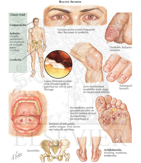 Arthritis Doctoral Thesis Service - Write a Ph.D. Dissertation about Arthritis Hypothesis