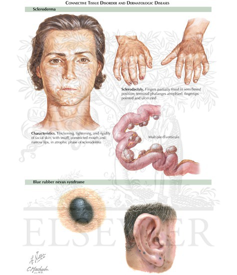 Small Bowel Manifestations Of Systemic Diseases Connective Tissue