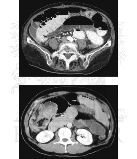 Watermarked preview of unlabeled image: Intestinal Obstruction (Continued): Computed Tomography of Small Intestine Obstruction