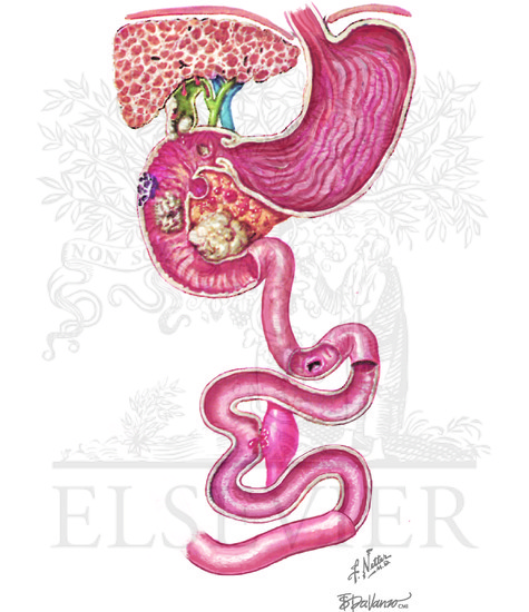 Vascular malformation of small intestine and other causes of small ...