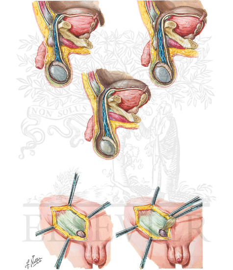 Indirect and Direct Inguinal Hernias (CONTINUED): The Funicular Process and Hernia in Infancy