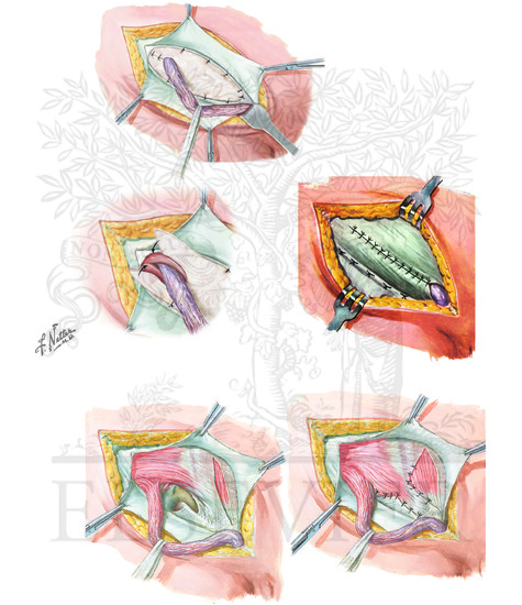 Indirect and Direct Inguinal Hernias (CONTINUED): Tension-free Hernia and McVay Repairs