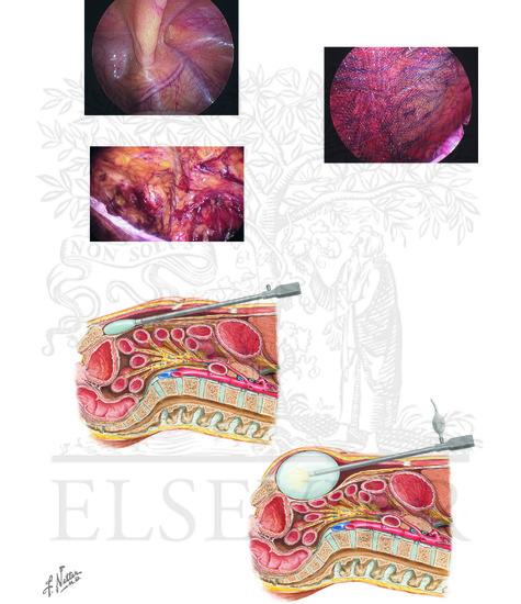 Watermarked preview of unlabeled image: Indirect and Direct Inguinal Hernias (CONTINUED): Transabdominal Preperitoneal and Totally Extraperitoneal Approaches to Inguinal Hernia