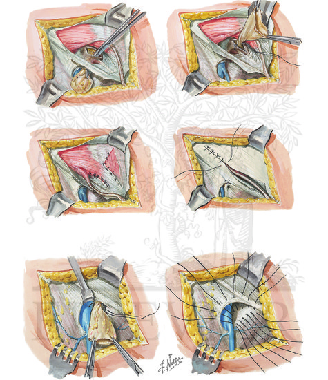 Femoral Hernia (CONTINUED): Surgical Repair of Femoral Hernia