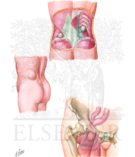 Watermarked preview of unlabeled image: Lumbar and Obturator Hernias