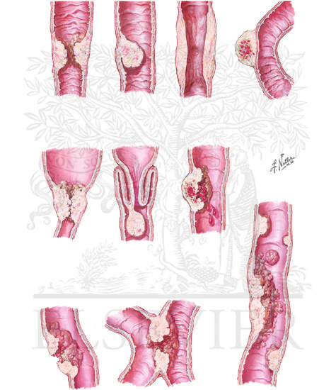 Watermarked preview of unlabeled image: Malignant Tumors of Small Intestine