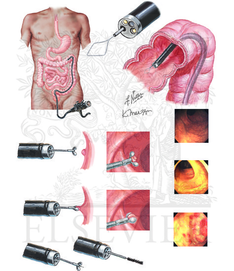 Biopsy and Cytology: Endoscopic Biopsy