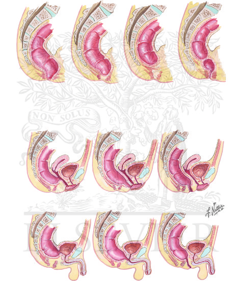 Congenital Intestinal Obstruction: Anorectal Malformations: Imperforate Anus