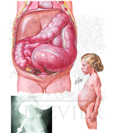 Watermarked preview of unlabeled image: Congenital Intestinal Obstruction: Hirschsprung's Disease: Typical Distention and Hypertrophy 