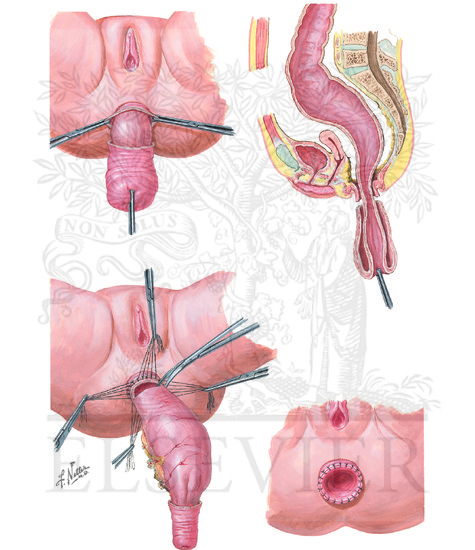 Watermarked preview of unlabeled image: Congenital Intestinal Obstruction: Hirschsprung's Disease (Continued): Surgical Repair