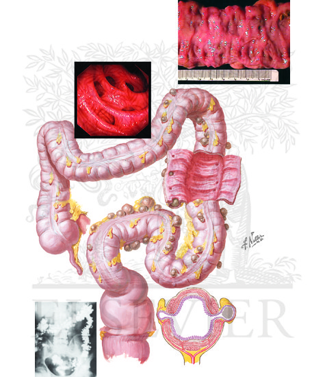 Watermarked preview of unlabeled image: Diverticulosis of Colon