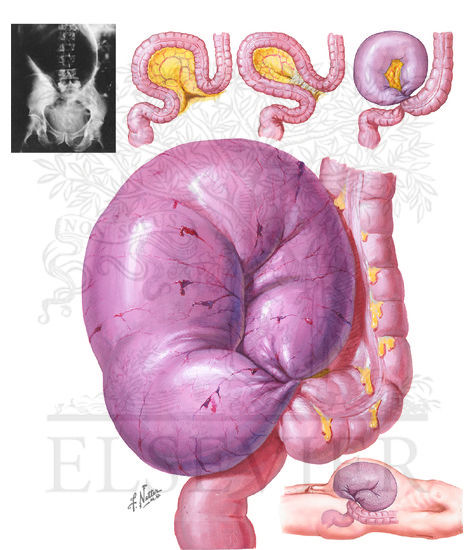 Volvulus of Sigmoid