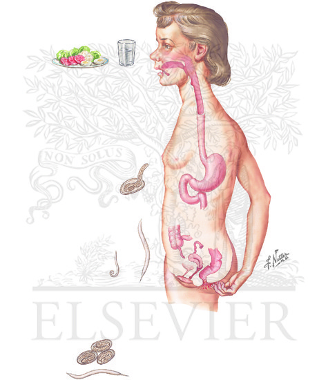 Watermarked preview of unlabeled image: Parasitic Diseases: Enterobiasis 