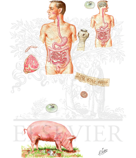 Watermarked preview of unlabeled image: Parasitic Diseases: Taeniasis Caused by Taenia solium (Cysticercus cellulosae)