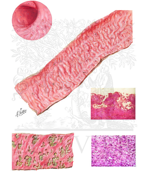 Amebiasis (CONTINUED): Histology and Scope images of amebiasis