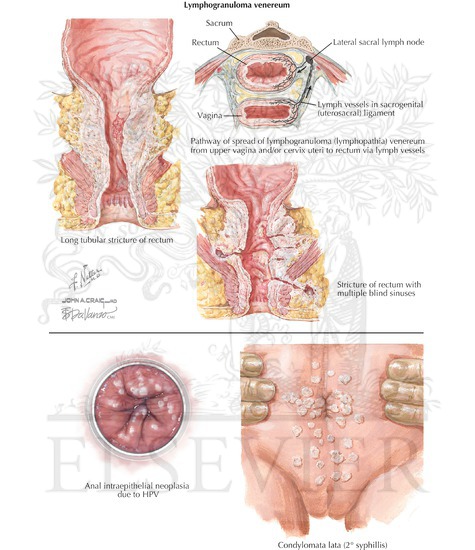 Proctologic Conditions: Sexually Transmitted Diseases