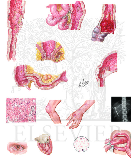 Watermarked preview of unlabeled image: Ulcerative Colitis (Continued): Etiologic Factors, Complications